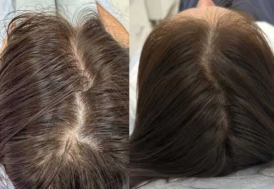Tratamiento con exosomas capilares antes y después