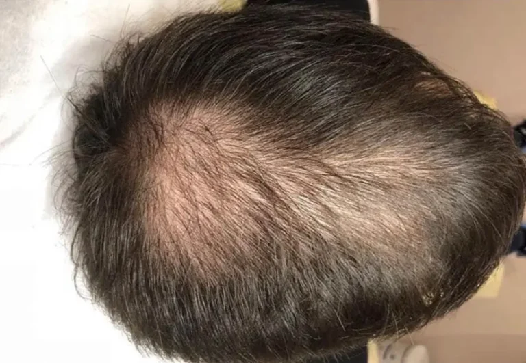 Tratamientos capilares antes y después con mesoterapia, caso 1