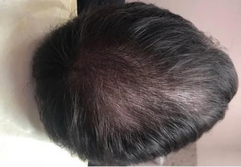 Tratamientos capilares antes y después con mesoterapia, caso 2