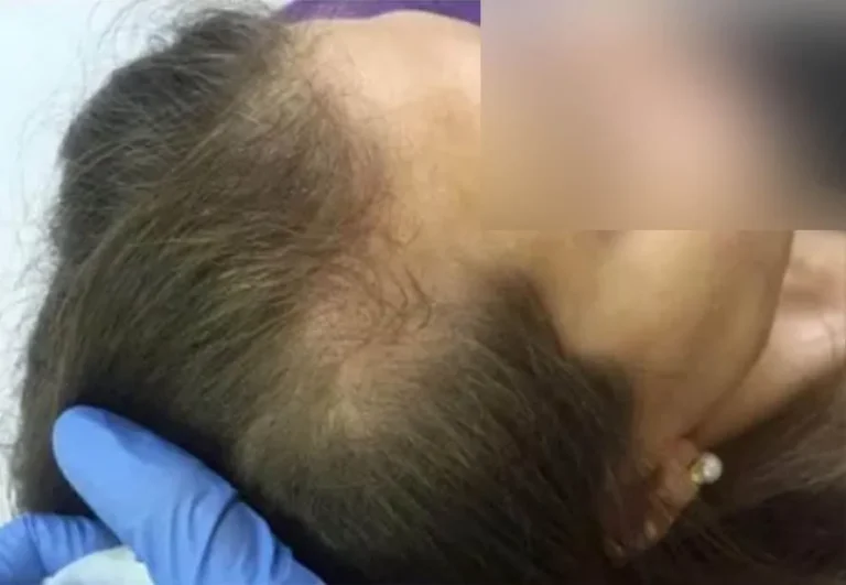 Mesoterapia capilar antes