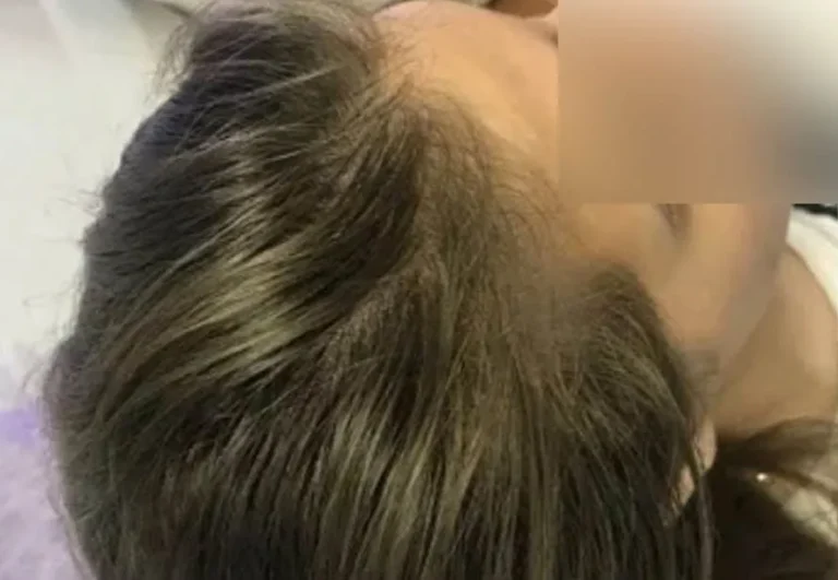 Mesoterapia capilar después