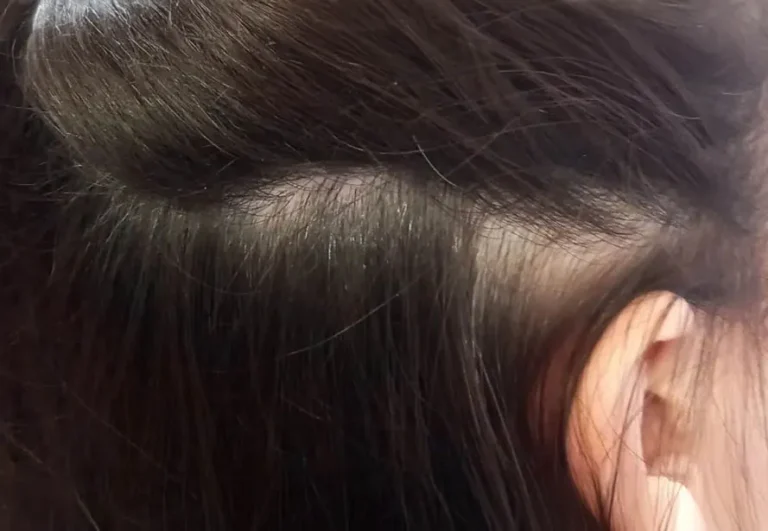 Recuperación de cabello después