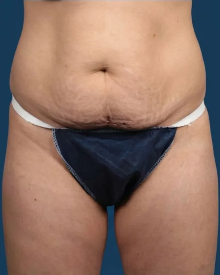 Abdominoplastia antes: abdomen con flacidez y piel sobrante, vista frontal – Clínica Ibiza