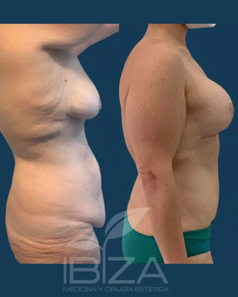 Abdominoplastia antes y después de perfil: reducción de la flacidez y la piel sobrante del abdomen – Clínica Ibiza