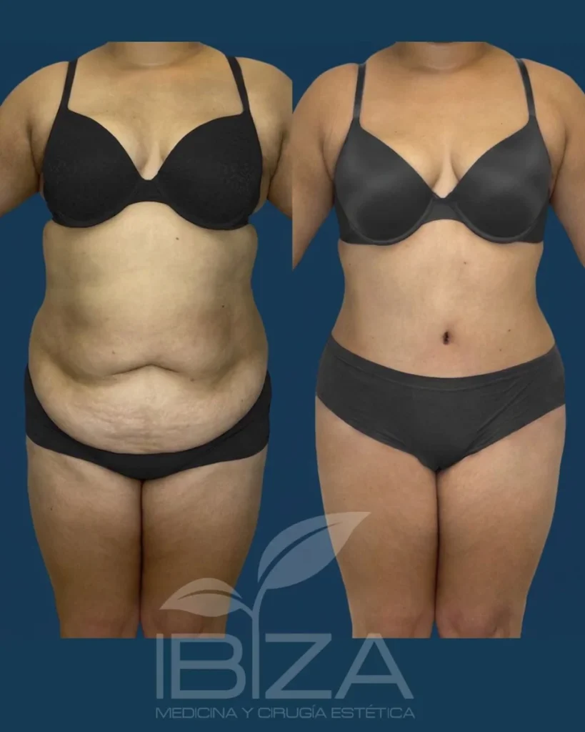 Abdominoplastia antes y después de frente: vientre más plano y cintura definida – Clínica Ibiza