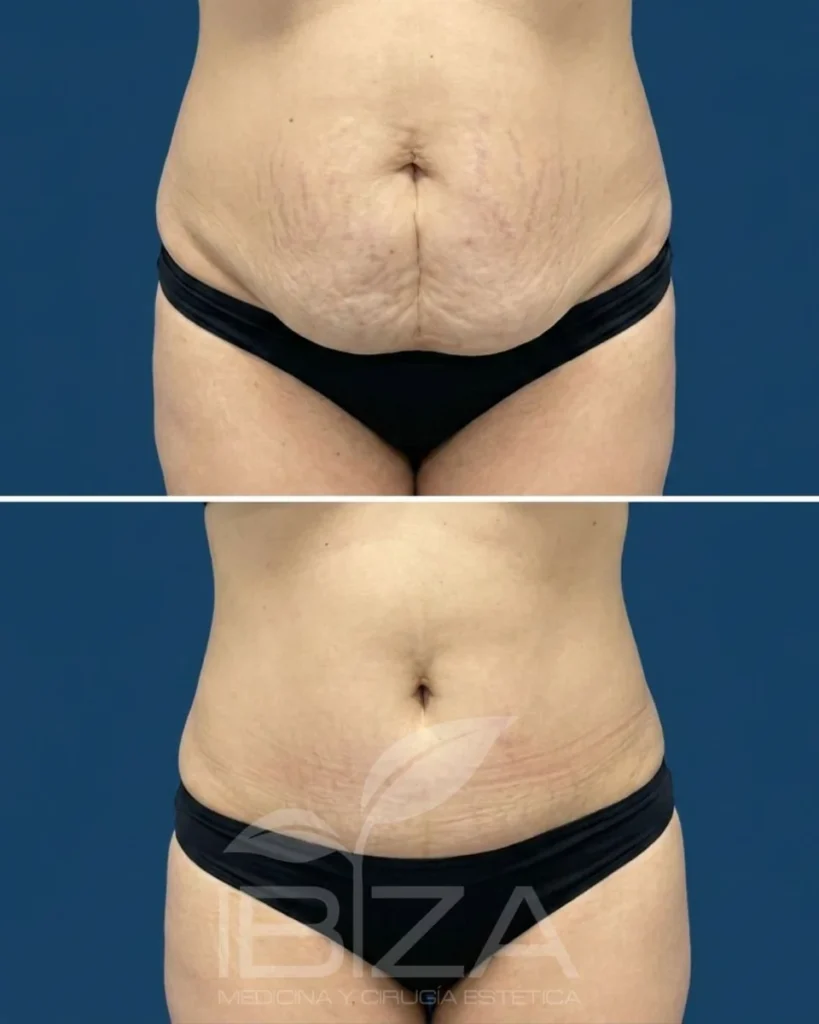 Abdominoplastia antes y después de frente: corrección de flacidez y estrías abdominales – Clínica Ibiza