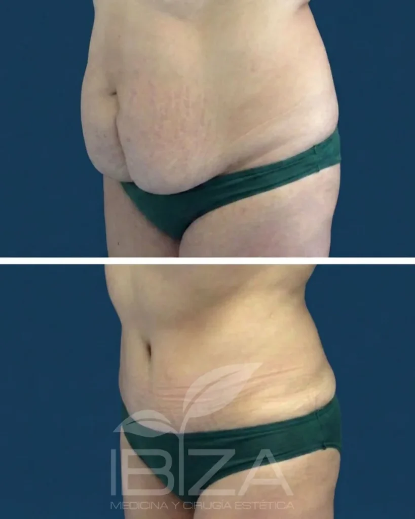 Abdominoplastia antes y después de perfil: abdomen más firme tras retirar la piel sobrante – Clínica Ibiza