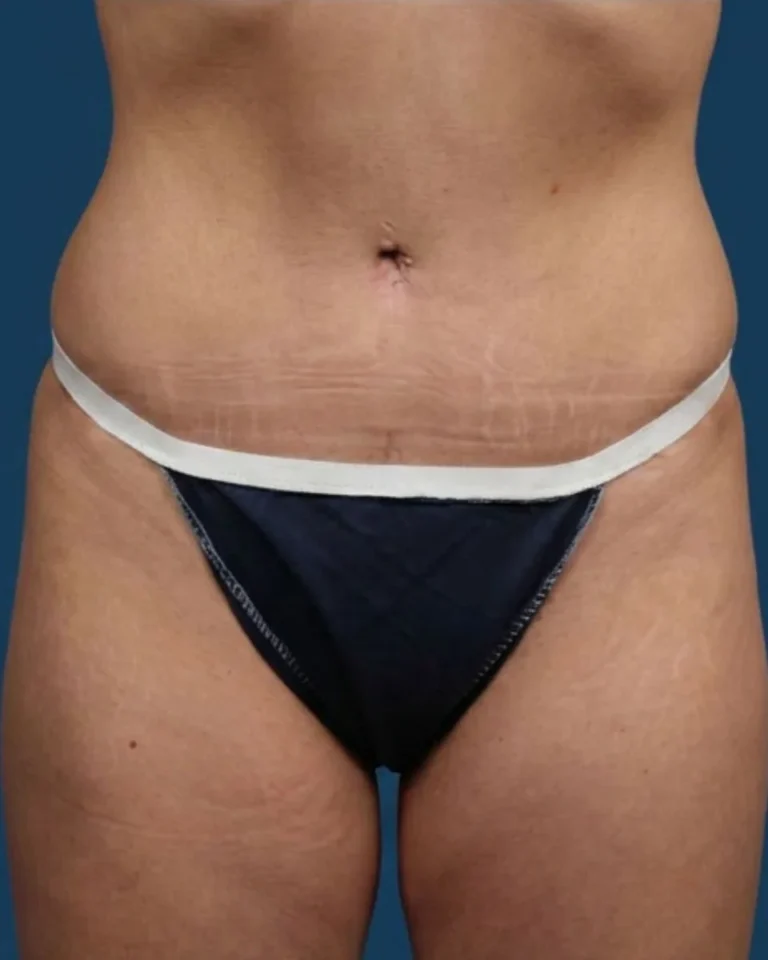 Abdominoplastia después: vientre plano y firme con cicatriz baja, vista frontal – Clínica Ibiza