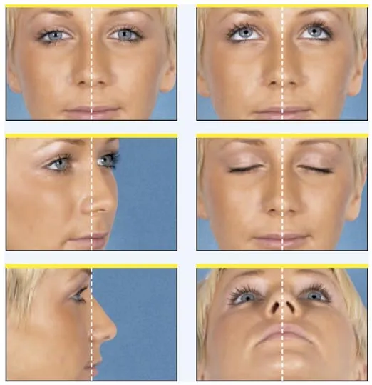Ejemplo de fotografías para nariz / rinoplastia